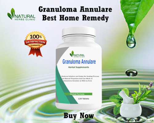 Home-Remedies-for-Granuloma-Annulare.jpg