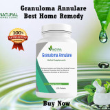 Home-Remedies-for-Granuloma-Annulare