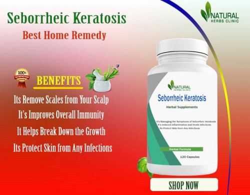 We will explore Home Remedies for Seborrheic Keratosis, offering you effective methods to bid farewell to these unwelcome skin growths. https://medium.com/@jesicasarah/home-remedies-for-seborrheic-keratosis-effective-at-home-treatment-6b39cf4b478c