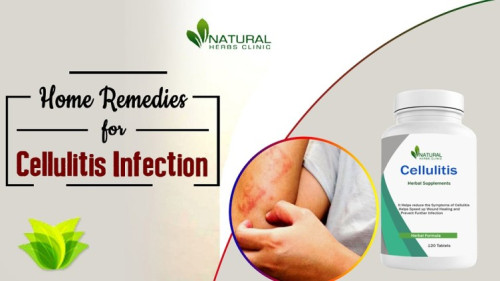 Cellulitis, a common bacterial skin infection, can be a painful and bothersome condition to deal with. While conventional medical treatments are available, there is a growing interest in natural remedies and Herbs For Cellulitis managing. https://techplanet.today/post/herbs-for-cellulitis-natural-treatment-and-remedies