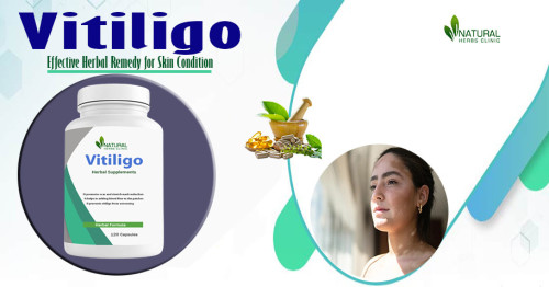 In your journey to manage vitiligo, embrace a holistic approach, and explore the potential benefits of a balanced Vitiligo Diet and Remedies, aloe vera, herbal treatments, and natural remedies. https://naturalherbsclinic.hpage.com/vitiligo-diet-and-remedies-a-better-way-to-deal-the-condition.html