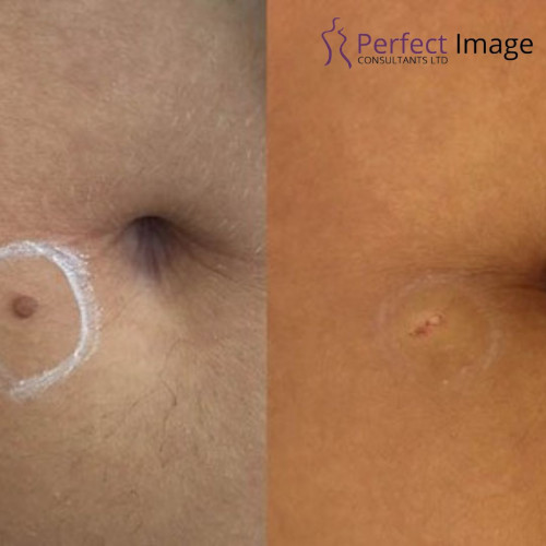 Wart, Skin tag and Mole Removal in London. Effective treatment at Perfect Image Consultants. Prices starting from £90, same day treatment available. Book appointment now at - +44 1895630604

https://www.perfectimageconsultants.co.uk/wart-skin-tag-mole-removal-london/