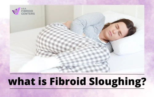 Discover the truth behind fibroid sloughing and its impact on women's health. Our latest blog post at USA Fibroid Centers delves into this important topic, providing valuable insights and guidance for those seeking relief from fibroids. Don't miss out on essential information! 
Read more now-
https://www.usafibroidcenters.com/blog/what-is-fibroid-sloughing/
