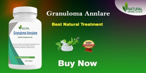 If you’re looking for a Natural Treatment for Granuloma Annulare, I highly recommend Natural Herbs Clinic. https://backethat.com/read-how-i-get-natural-treatment-for-granuloma-annulare/