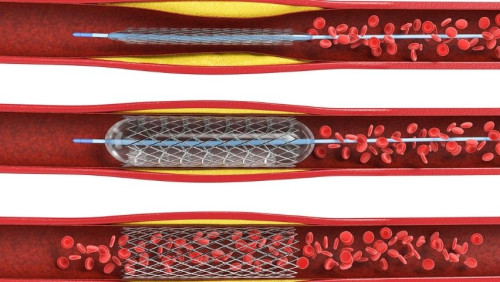 Angioplasty is a minimally invasive procedure used to open up blocked arteries to increase circulation. Schedule a consultation with a vascular specialist today!