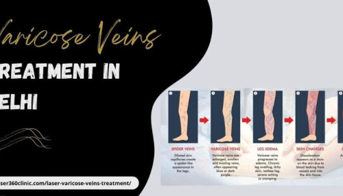 Are you concerned about the Delhi varicose veins laser treatment cost? If so, Laser360Clinic frees you of this anxiety as well.
https://laser360clinic.com/benefits-of-availing-top-varicose-veins-treatment-at-laser360clinic/